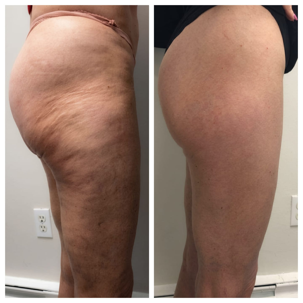 Antes y después de clienta con Softivelle