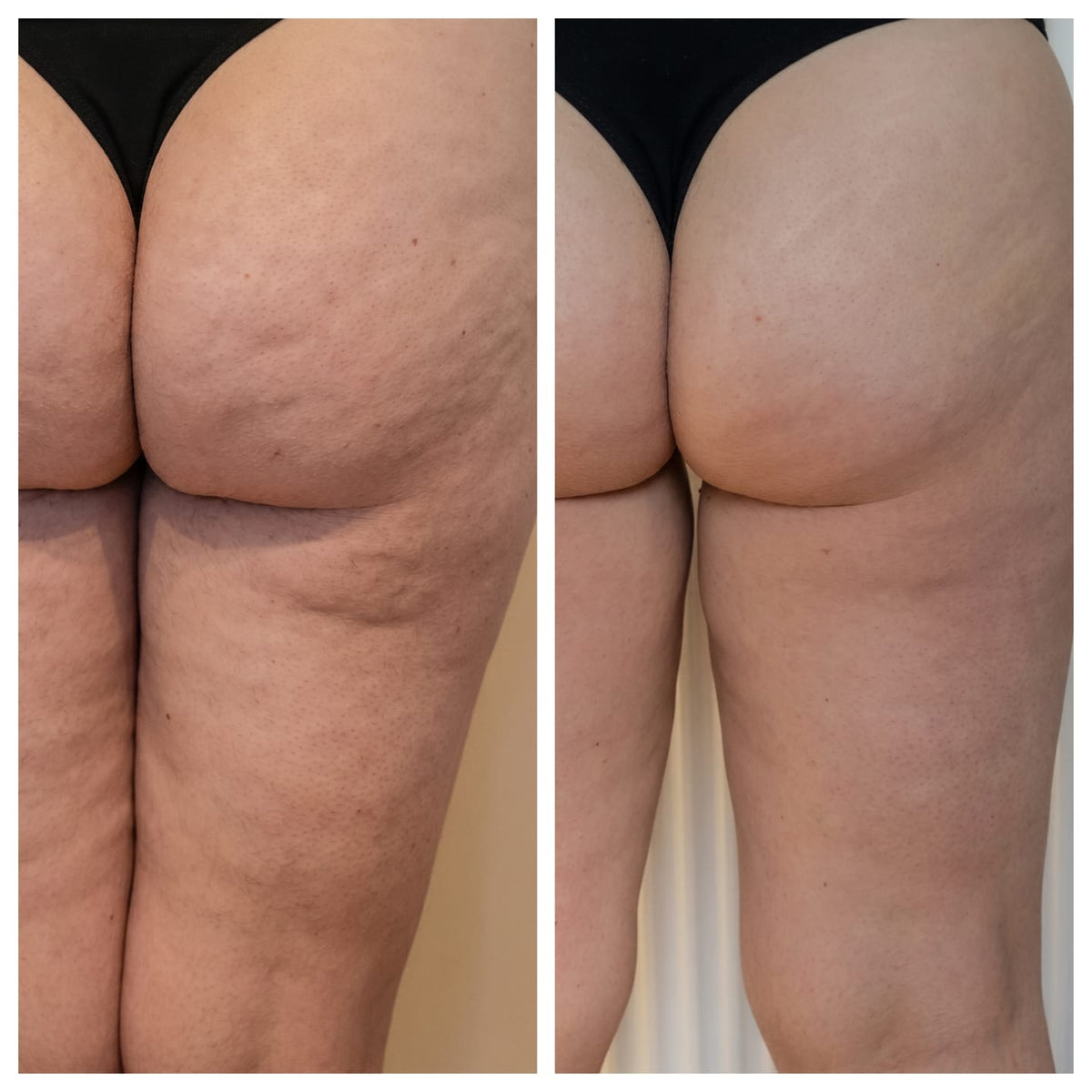 Antes y después de clienta con Softivelle